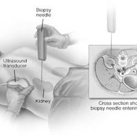 Диагностика почечной недостаточности