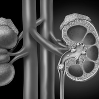 Камни почки