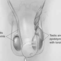 Абсцесс мошонки