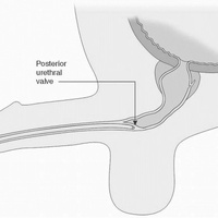 Клапаны уретры