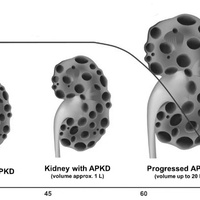 Поликистоз почек у взрослых