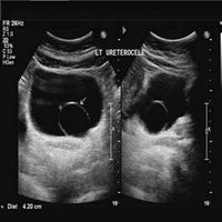 Уретероцеле