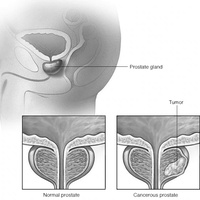 Рак предстательной железы