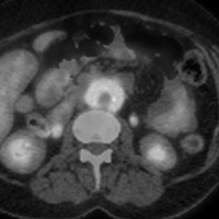 Ретроперитонбальный фиброз