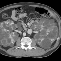 Диагностика объемных образований почек