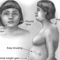 Синдром кушинга