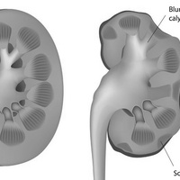 Пиелонефрит