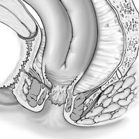 Пузырно-влагалищный свищ