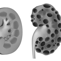 Врожденные кистозные заболевания почек