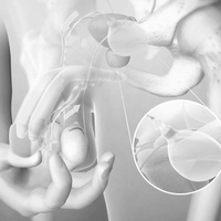 Пластика полового члена