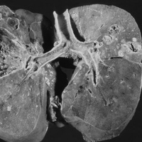 Туберкулез почки