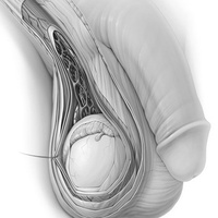 Сперматоцистит