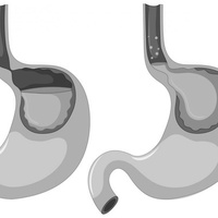 Пузырно-мочеточниковый рефлюкс