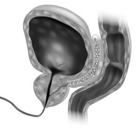 Гонококковые и негонококковые уретриты