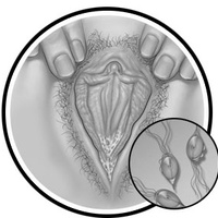 Трихомониаз