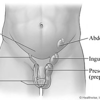 Крипторхизм