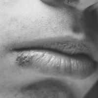 Половой герпес