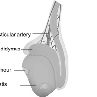 Новообразования мошонки у взрослых
