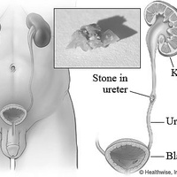 Камни мочеточника