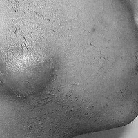 Телец Донована, или донованоз