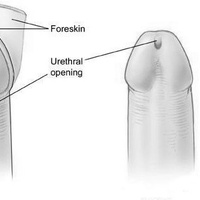 Гипоспадия