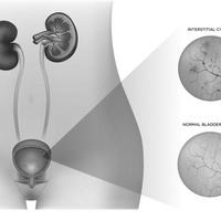Интерстициальныи цистит