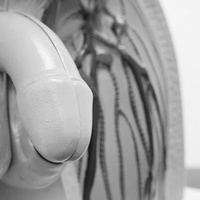 Варикоцеле