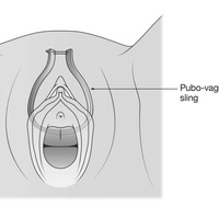 Интерлабиальные объемные образования