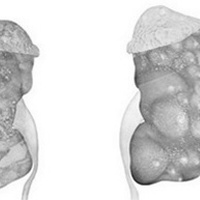 Почечный абсцесс