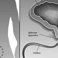Приобретенная стриктура мочеиспускательного канала