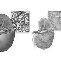 Повреждения почки